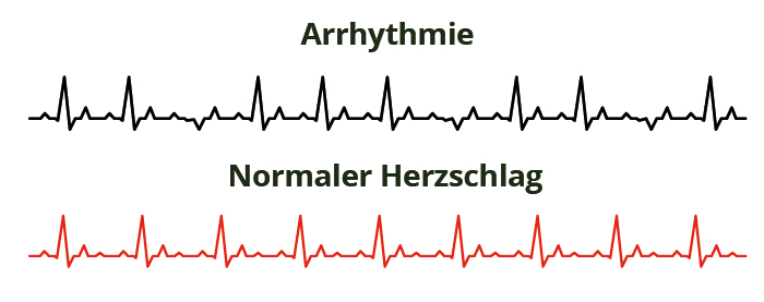 Herzrhythmusstörungen